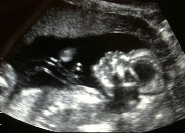Baby Lowman ultrasound